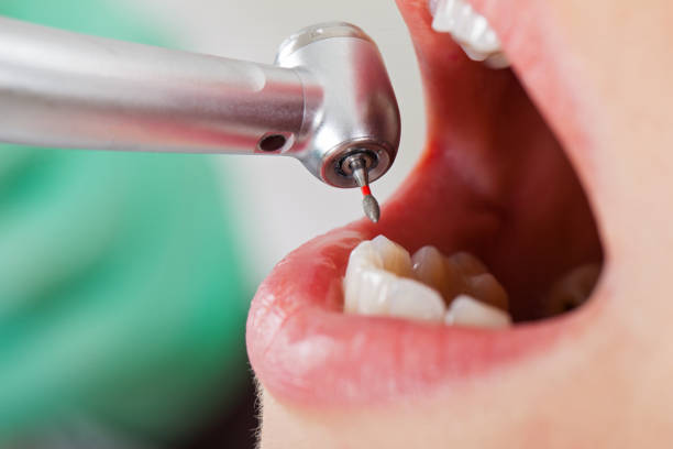 Best Emergency Dental Extractions in Honey Grove, TX